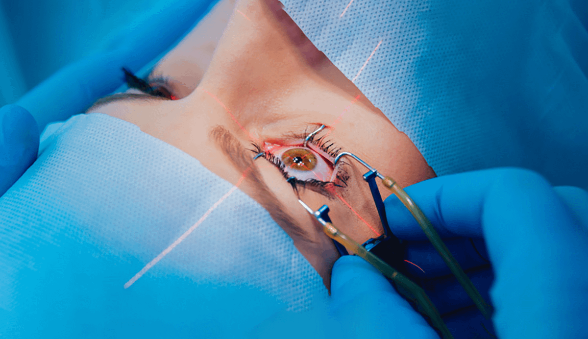 Глаз с векорасширитель во время лазерной процедуры